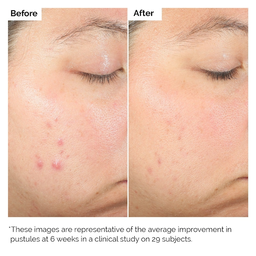 The Ordinary Salicylic Acid 2% Solution 30ml
